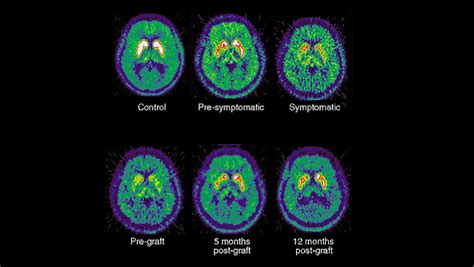 Dopamine and Movement