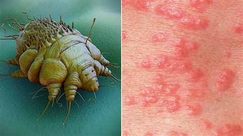 Scabies: Causes, Rash Signs & Treatment Options