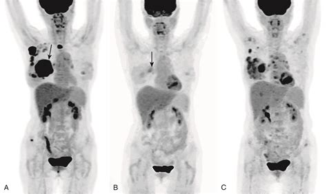 Breast Cancer Metastases-Bone | PracticeUpdate