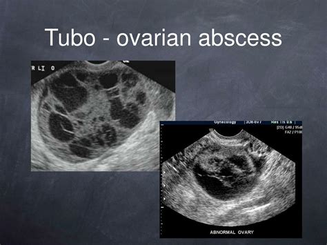 Tubo Ovarian Abscess On Ultrasound