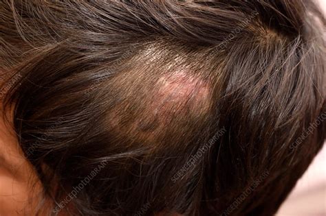 Ringworm fungal infection of the scalp - Stock Image - C037/2259 ...