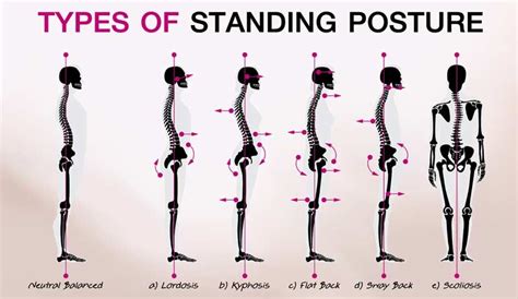 Kyphosis Lordosis Exercises