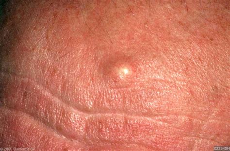 epidermoid cyst pictures - pictures, photos