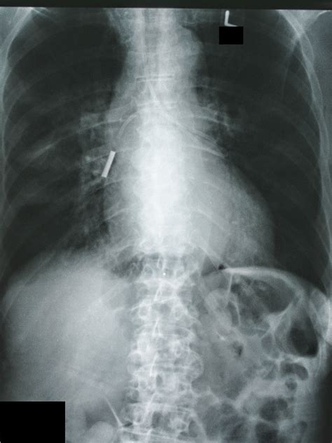 Why confirmation of feeding tube placement is important. : r/Radiology