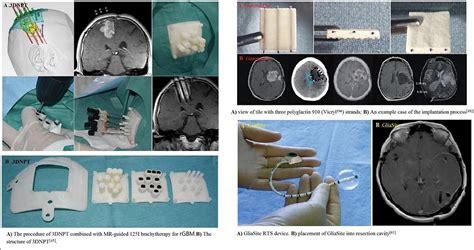 Brachytherapy is an effective and safe salvage option for re ...