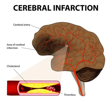 Cerebral infarction or ischemic stroke — Stock Vector © edesignua #53168923