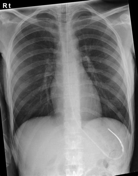 Assessing Nasogastric (NG) Tube Placement | Geeky Medics