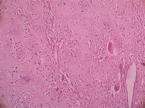 chondrosarcoma 9 – Histopathology.guru