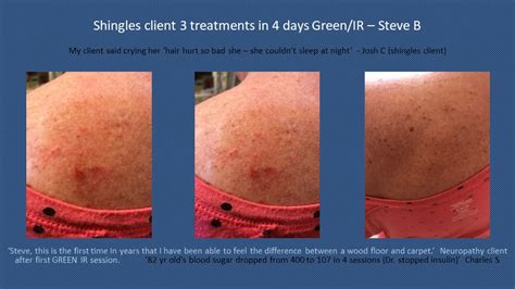 Red Light Therapy for Shingles - Red Light Bed Therapy - ARRC LED