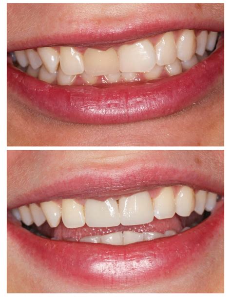 Teeth Veneers Before And After