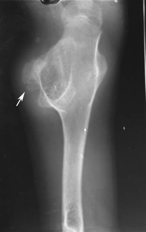 Radiodiagnosis - Imaging is Amazing-Interesting cases: Secondary ...