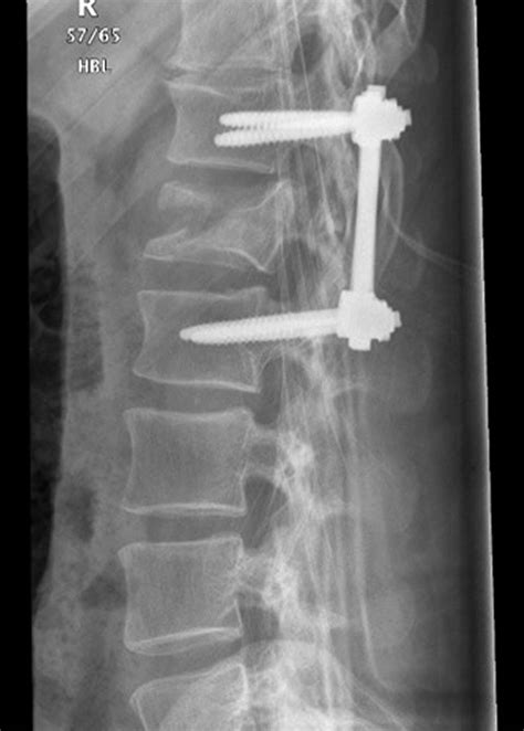 Icd 10 Code For Closed Fracture 4th Vertebrae