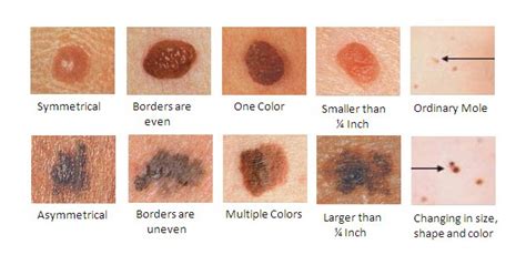 All About Moles - The Skiny