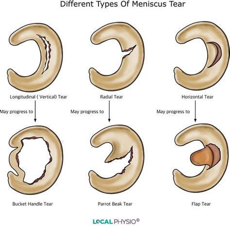 Meniscus Tears: Sports Medicine Doctor Mesa AZ, Orthopedic Surgeon