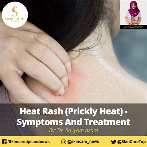 Heat Rash (Prickly Heat) - Symptoms And Treatment