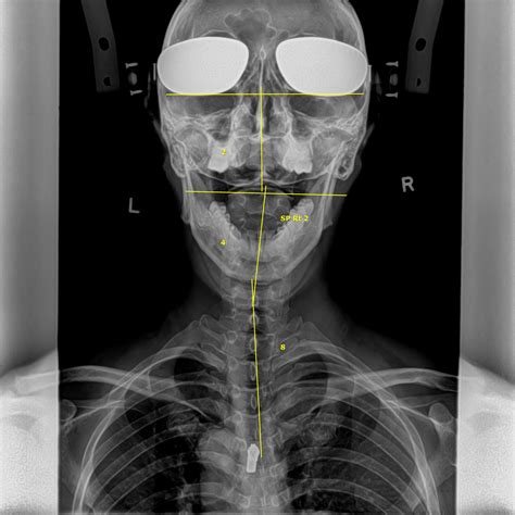 What are X-rays? | ALL WELL Scoliosis Centre - Singapore Chiropractic ...