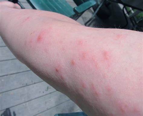 Poison Ivy Rash | Medical Point