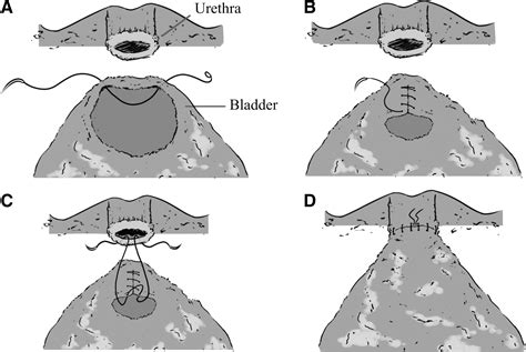 The Impact of Three Different Bladder Neck Reconstruction Techniques on ...