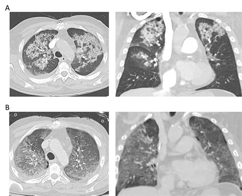 Cureus | Diffuse Alveolar Hemorrhage Secondary to Ibrutinib Therapy in ...