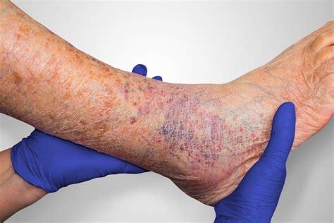 6 things to know when treating venous leg ulcers - Medline