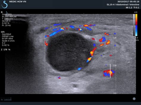 VIETNAMESE MEDIC ULTRASOUND: CASE 459 : CERVICAL LYMPH NODES, Dr PHAN ...