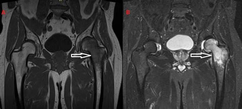 Cureus | Lower Limb Pain Attributed to Bone Marrow Edema Syndrome: A ...