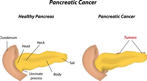 Shape-Shifting Pancreas Cells Set Stage for Development of Deadly ...