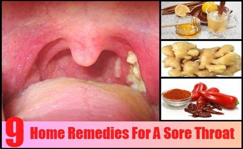 9 Top Home Remedies For A Sore Throat - Natural Treatments & Cure For ...