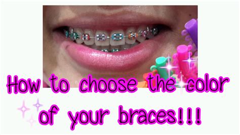 31+ Best Colors For Braces PNG