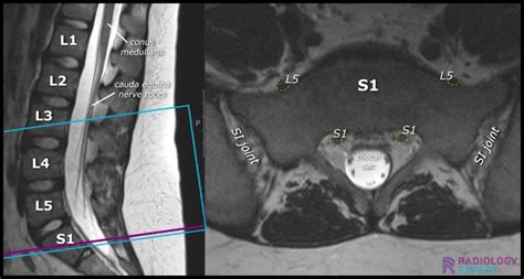 MRI Lumbar Spine