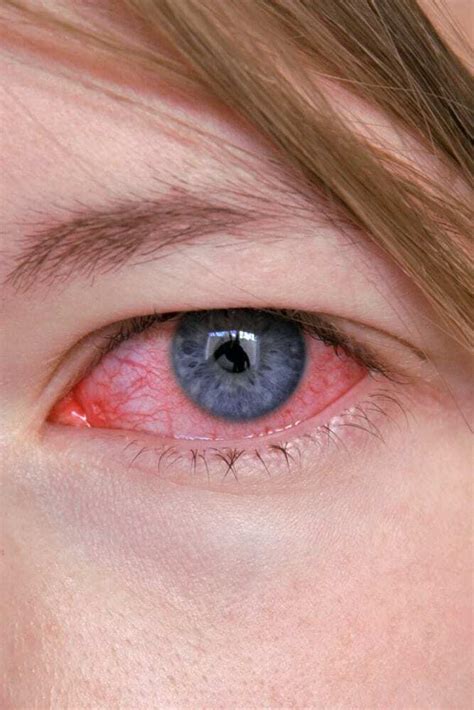 What Causes Pink Eye? - Heffington's House of Vision