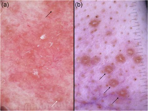 (a) Granulomatous rosacea, displaying a few linear vessels and multiple ...