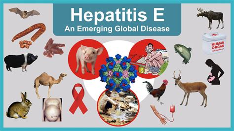 Hepatitis E - How Do You Get Hepatitis E & Is it Curable?