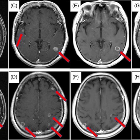 (A, B) A single brain metastasis was detected before chemotherapy. (C ...