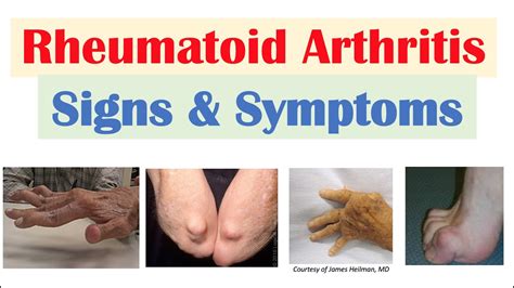 Rheumatoid Arthritis (RA) Signs & Symptoms (& Associated Complications ...