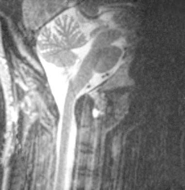 Herniated Disc Thoracic Mri