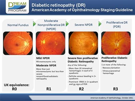 Diabetic Retinopathy Stages