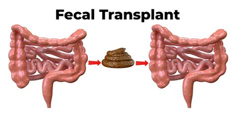 Fecal Microbiota Transplantation Is A Procedure In Which A Donors Feces ...