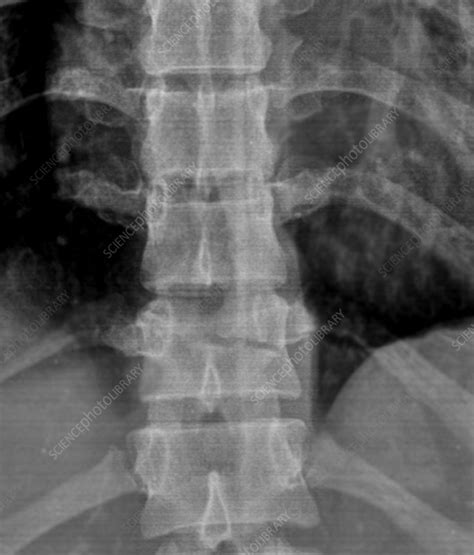 Thoracic spine fracture, X-ray - Stock Image - C052/8788 - Science ...