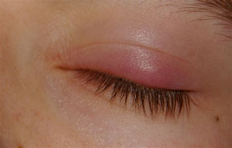 Sty Symptoms: What are the Indications of Eye Stye