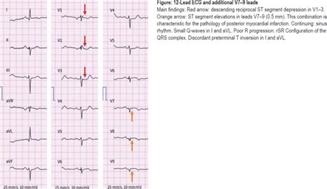 Posterior Myocardial Infarction—a Hidden ECG Emergency Presentation (09 ...