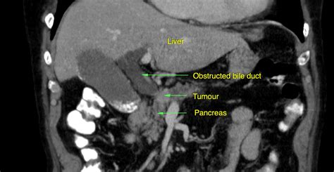 Blocked Bile Ducts – PTC – Sydney Medical Interventions