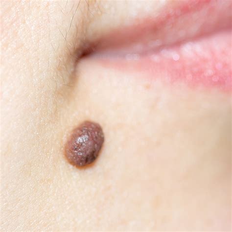 Dermal naevus (mole) | Spot Check: skin cancer + aesthetics. Melbourne CBD