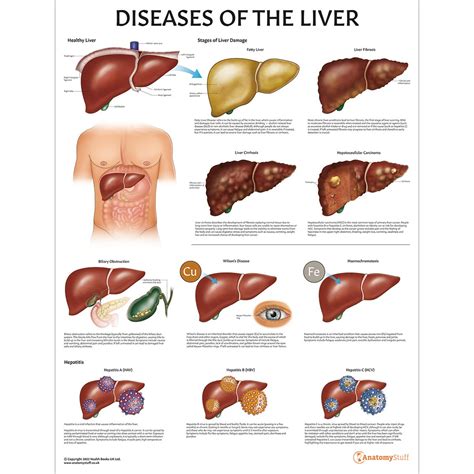 Diseases of the Liver Chart/Poster Laminated