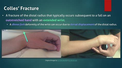 Colles fracture - smartspery