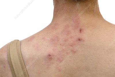 Shingles on the neck - Stock Image - C021/5604 - Science Photo Library