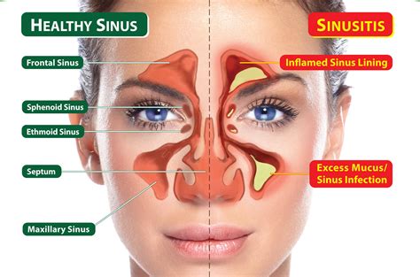 Sinus Headache - Causes, Symptoms, Relief & Treatment