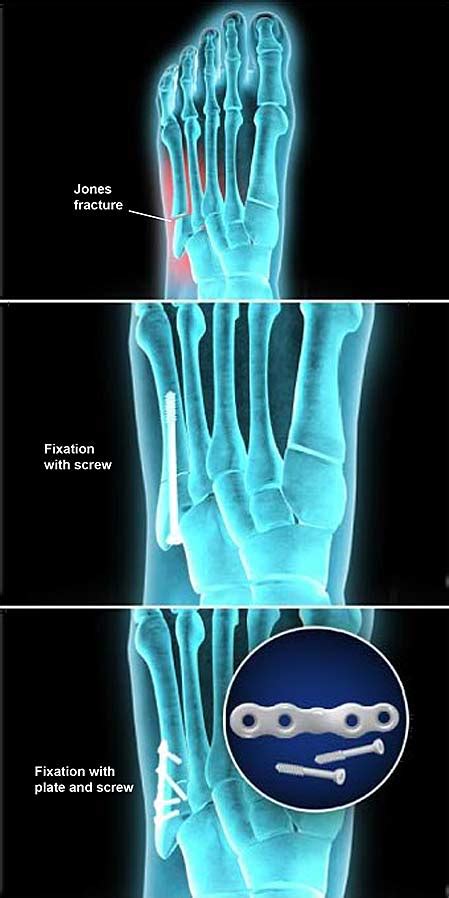 Jones Fracture Fixation (Open Reduction and Internal Fixation ...