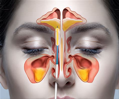 Sinus Surgery - Facts, Preparation, Operative Procedure, Recovery ...