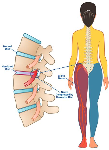 5 Unexpected Symptoms of a Herniated Disc | CORE Orthopedics